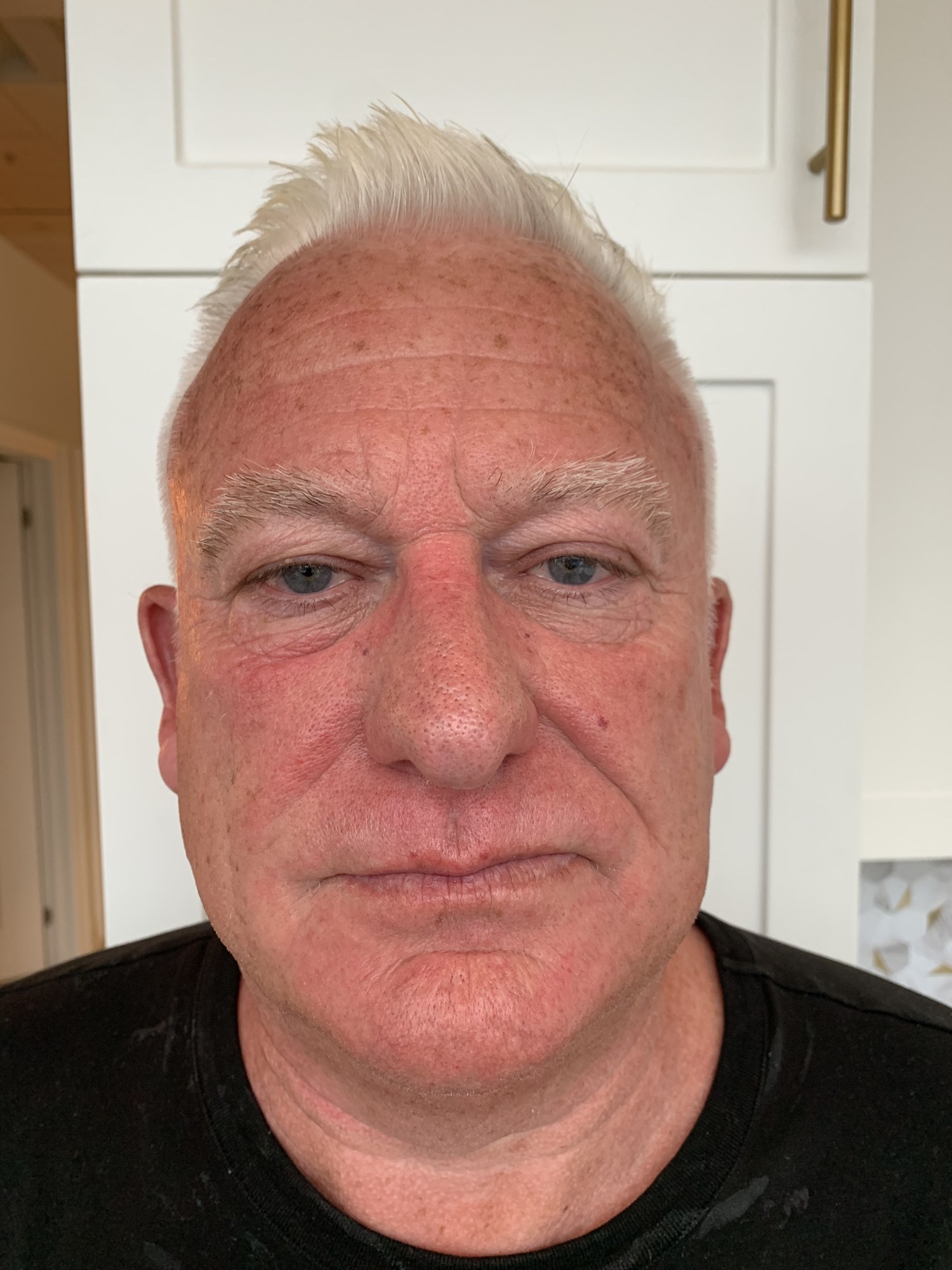 After Morpheus8 treatment — patient result at Essential Health Clinic