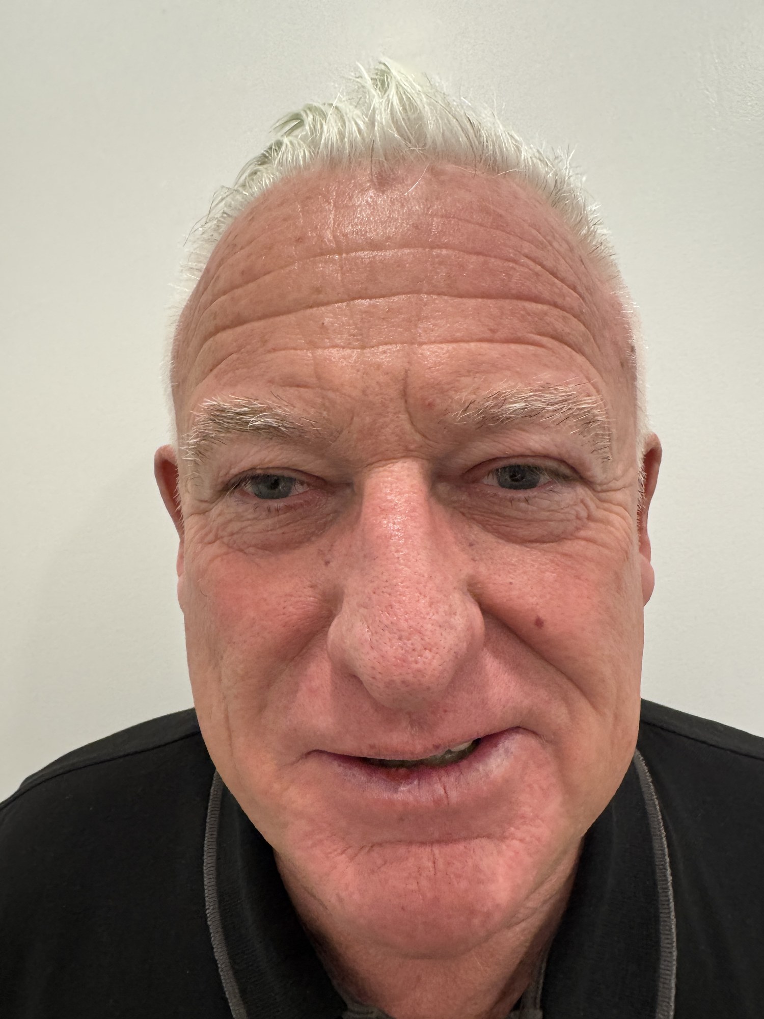Before Morpheus8 treatment — patient result at Essential Health Clinic